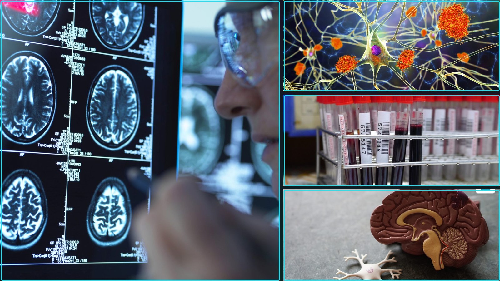 Dementia September 21, 2026: Alzheimer’s diagnosis in 18 weeks: New target for NHS